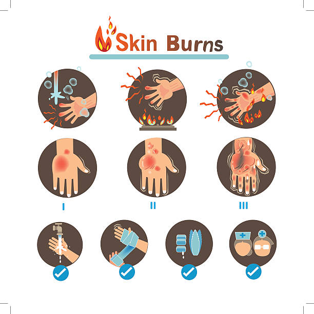 Burns vector art illustration