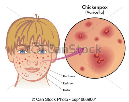 chickenpox - medical illustration of the symptoms of... ...