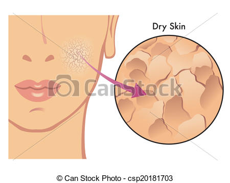 ... dry skin - medical illustration of the effects of dry skin