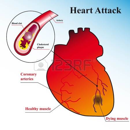 heart disease: Schematic explanation of the process of heart attack